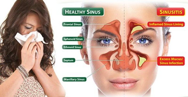 Acute Sinusitis Getcured Apothecary Pvt Ltd