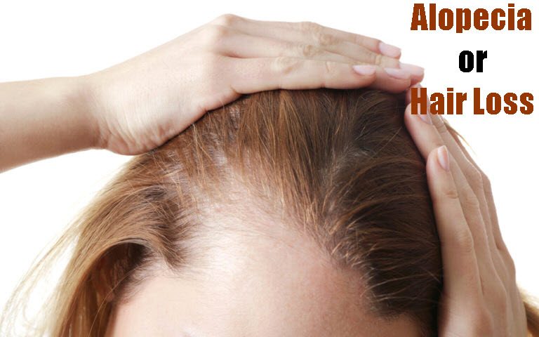 Alopecia or Hair Loss