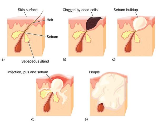 Causes of Acne or Pimples