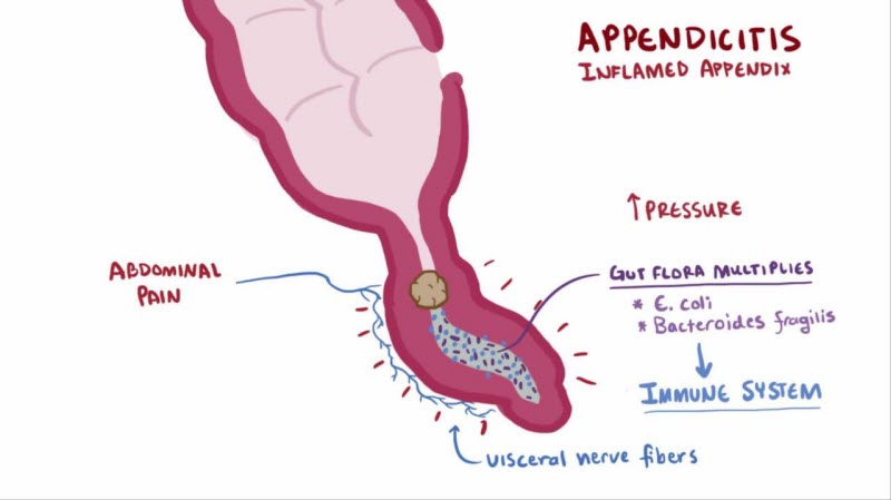 Causes of Appendicitis