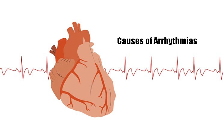 Causes of Arrhythmias