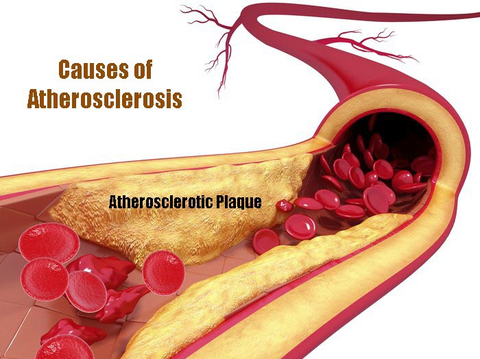 Causes of Atherosclerosis