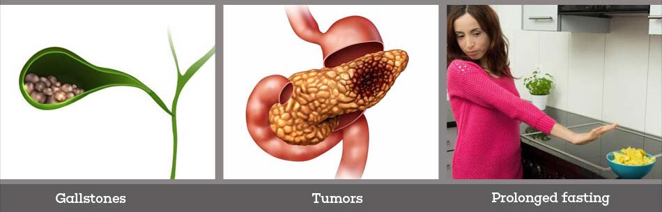 Causes of Cholecystitis