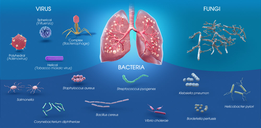 Causes of Pneumonia