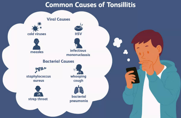 Causes of Tonsillitis