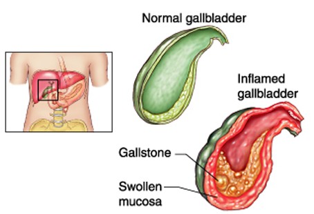 Cholecystitis Introduction