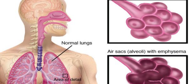 Chronic Obstructive Pulmonary Disease (COPD)