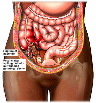 Complications of Appendicitis