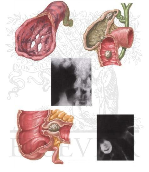 Complications of Cholecystitis