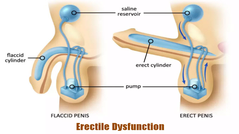 Erectile Dysfunction Getcured Apothecary Pvt Ltd