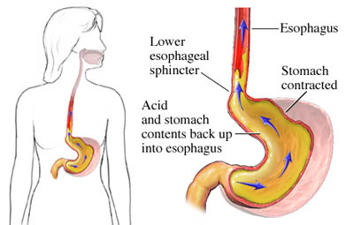 GERD or Heartburn Definition