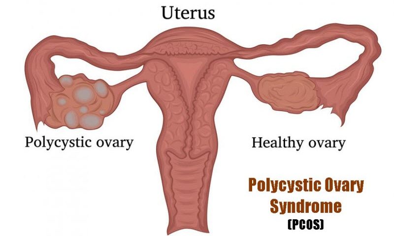 Polycystic Ovary Syndrome (PCOS or PCOD)