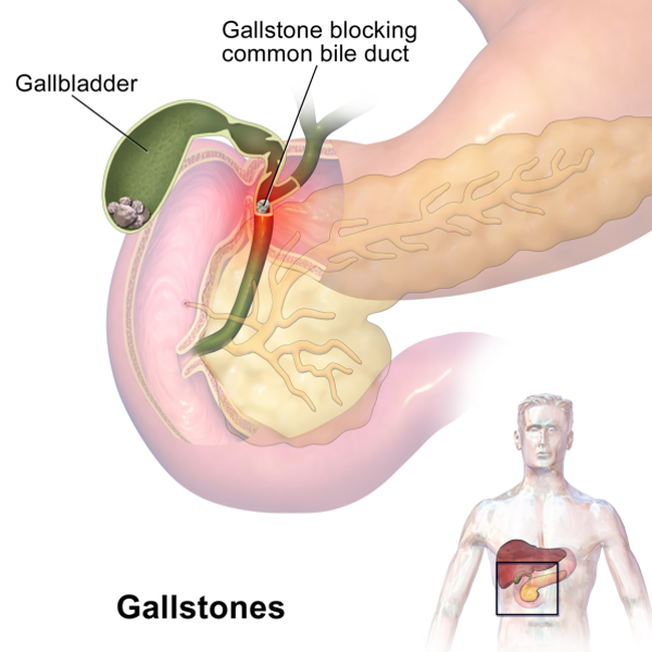 Risk Factors for Cholecystitis