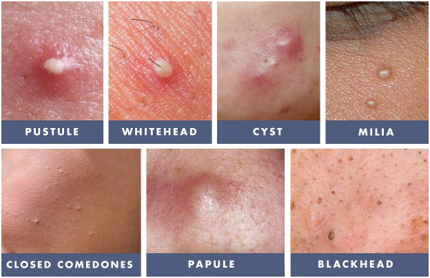 Signs and Symptoms of Acne - Different Types of Pimples