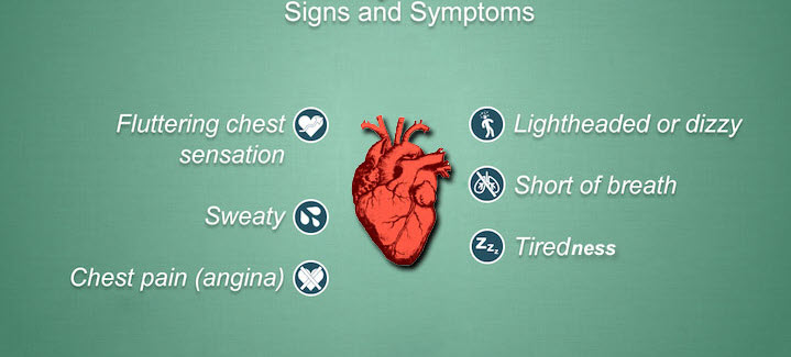 arrhythmia symptoms