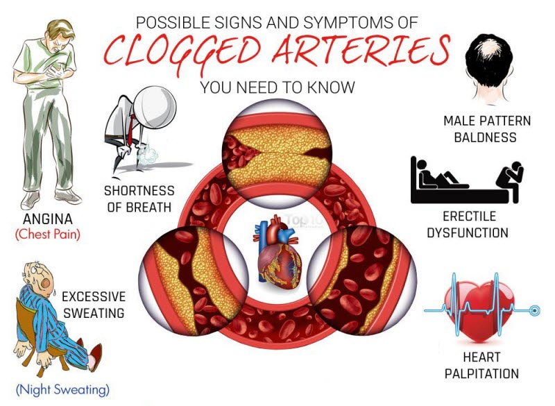 Atherosclerosis | Getcured Apothecary Pvt Ltd