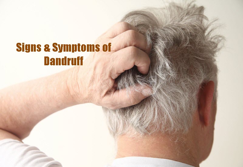 Signs and Symptoms of Dandruff
