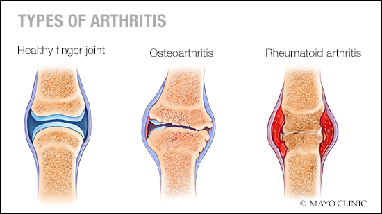 Types of Arthritis
