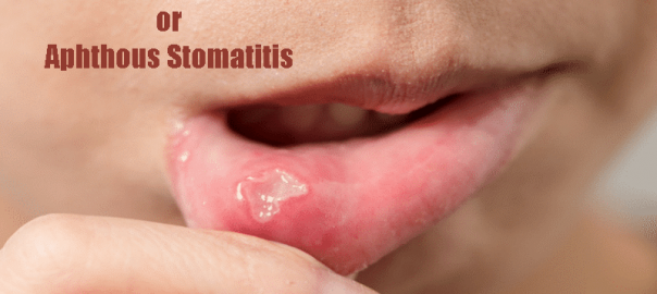 Canker Sore or Aphthous Stomatitis