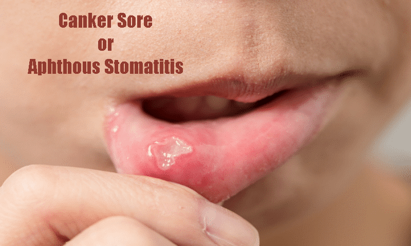 Canker Sore or Aphthous Stomatitis