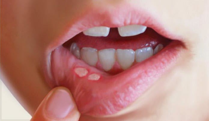 Canker Sore Getcured Apothecary Pvt Ltd