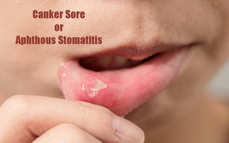 canker-sores-causes-symptoms-treatment-and-medication