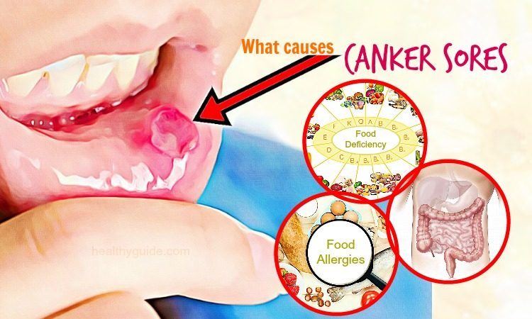 Causes of Canker Sores