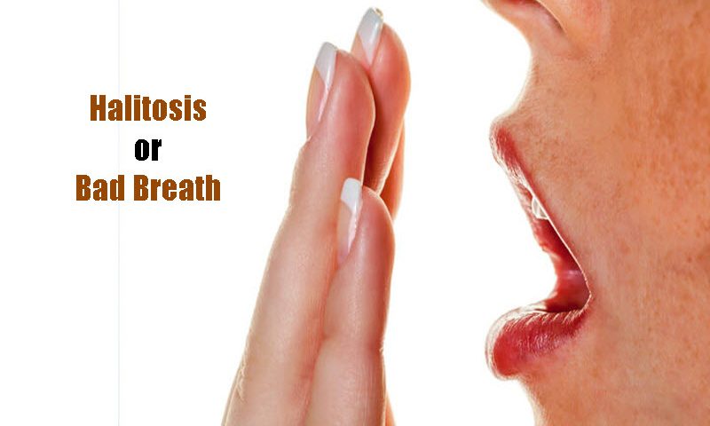 Halitosis or Bad Breath