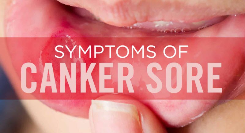 Signs and Symptoms of Canker Sores