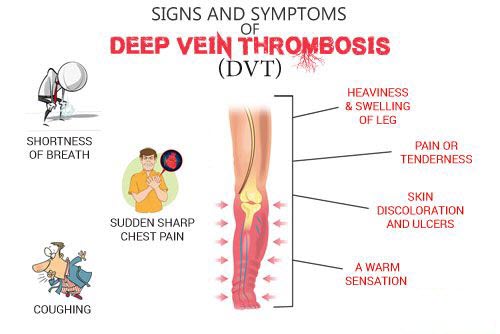 Deep vein thrombosis symptoms and treatment